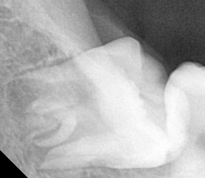강남레옹치과 사랑니 발치 전문! 아프기 전에 미리 뽑아주세요! 관련 이미지 3