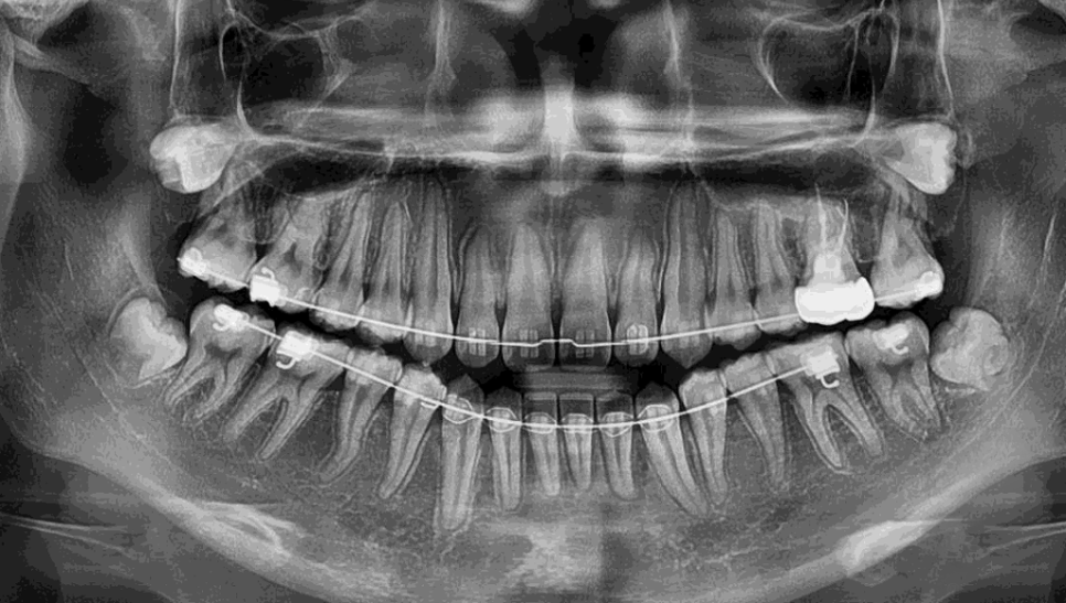강남레옹치과 사랑니 발치 전문! 아프기 전에 미리 뽑아주세요! 관련 이미지 4