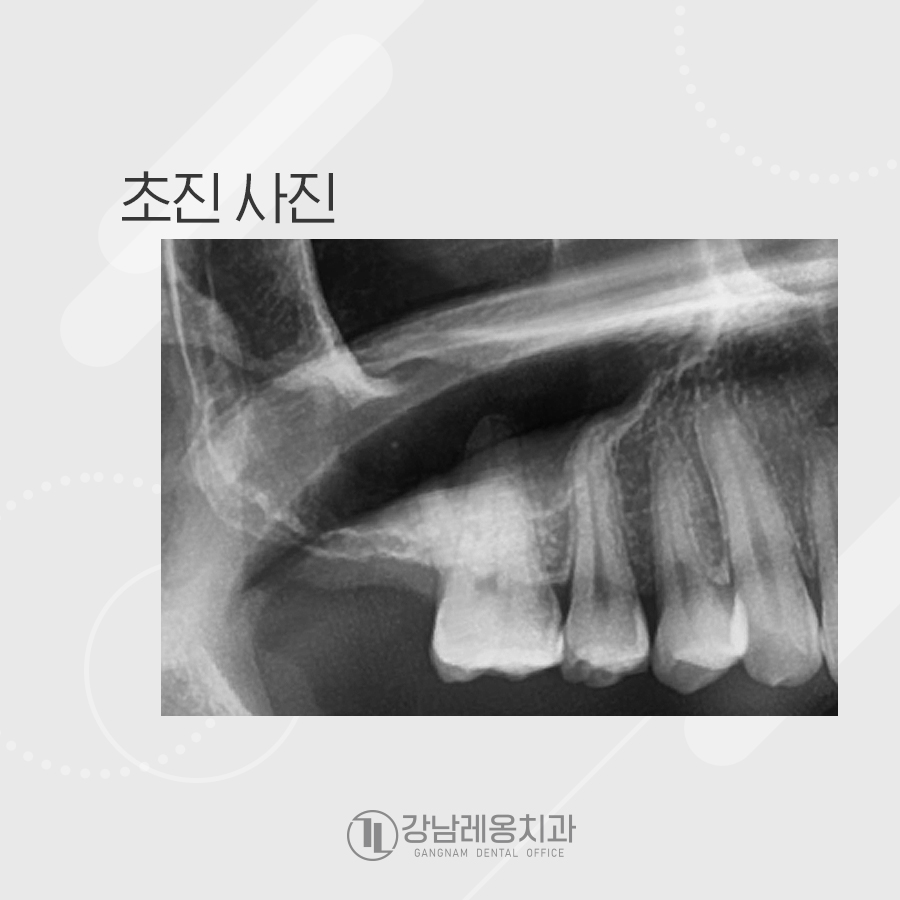 뼈가 얇아 상악동거상술과 뼈이식 후 임플란트 관련 이미지 2