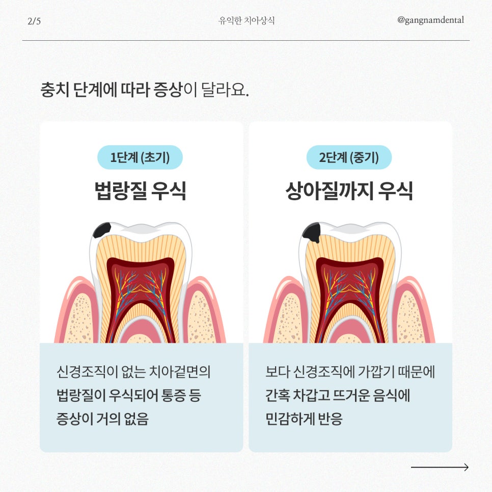 강남레옹치과에서 알려드리는 충치가 생기는 의외의 이유! 관련 이미지 3