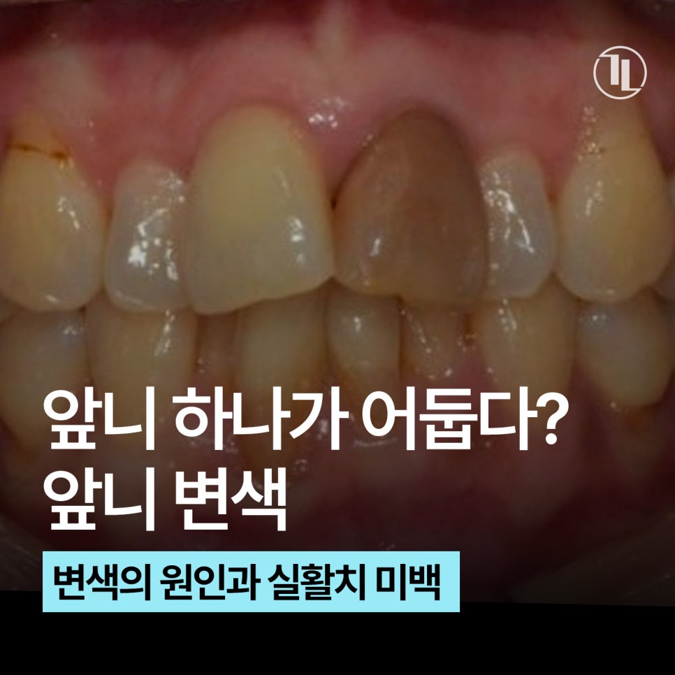 앞니 하나가 어두워졌다? / 앞니 변색 원인과 실활치 미백 과정 / 강남레옹치과 관련 이미지 1