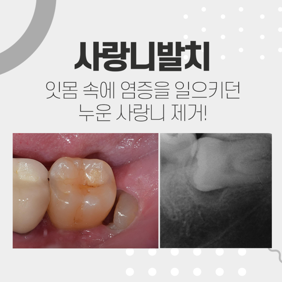 누운 사랑니 발치, 신경관과 겹쳐있는데 강남레옹치과에서 가능한가요? 관련 이미지 1