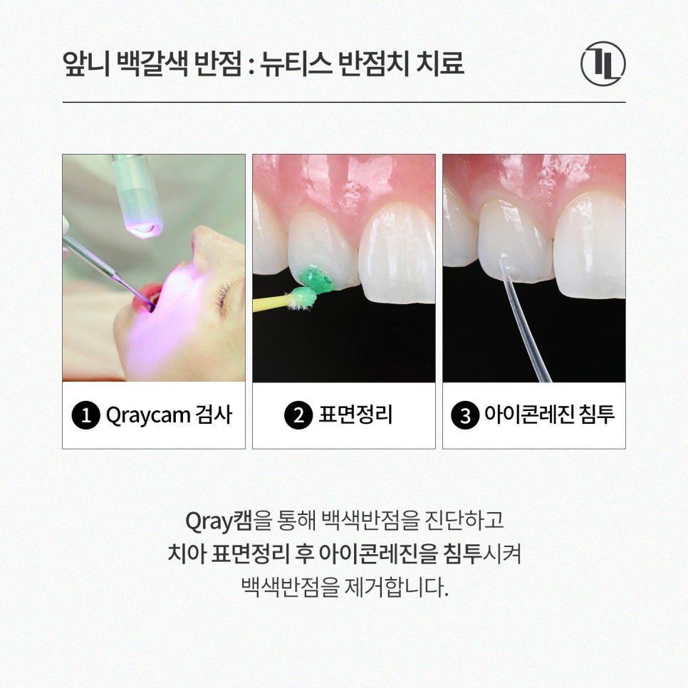 앞니 하얀점, 뉴티스 반점치 제거로 당일 개선 / 강남레옹치과 관련 이미지 5