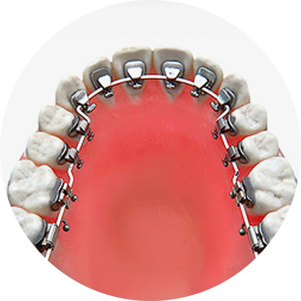 치아교정 종류와 선택법 & 관리 꿀팁 5가지!🖐️ / 강남레옹치과 관련 이미지 5