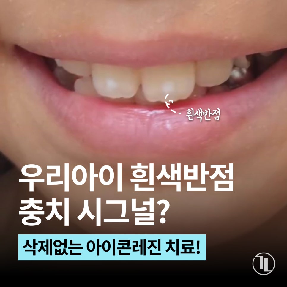우리 아이 앞니에 하얀 반점! 소아 충치 시작의 신호? / 강남레옹치과 관련 이미지 1