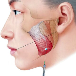 보톡스의 또 다른 활용법? 턱관절 통증 치료💉 / 강남레옹치과 관련 이미지 3