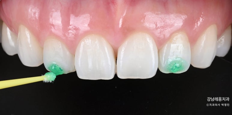 앞니 하얀얼룩, 하루만에 제거! 뉴티스 반점치 치료 / 강남레옹치과 관련 이미지 4