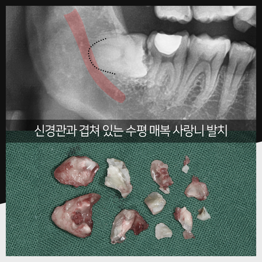 강남레옹치과 사랑니 발치, 결과가 증명해주는 실력! 관련 이미지 19