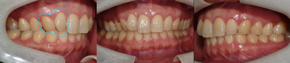 치과의사가 직접 경험한 인비절라인 특징과 진행과정👨&zwj;⚕️ / 강남레옹치과 관련 이미지 5