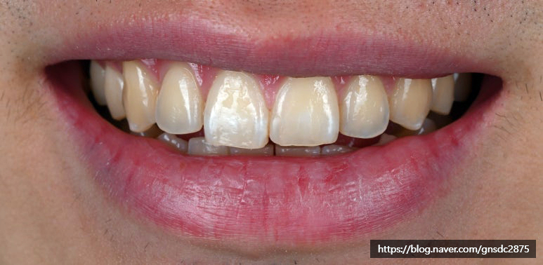 깨진 앞니 길이가 긴 앞니, 법랑질 성형 알아보기🔎 / 강남레옹치과의원 관련 이미지 5