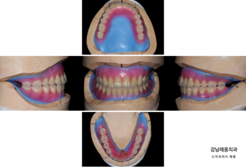 만 65세 이상 틀니 보험적용 혜택과 과정💫 / 보훈위탁병원 강남레옹치과 관련 이미지 6