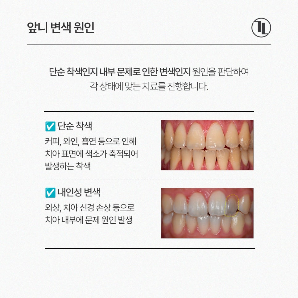 앞니 하나가 어두워졌다? / 앞니 변색 원인과 실활치 미백 과정 / 강남레옹치과 관련 이미지 2