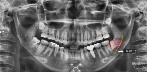 강남레옹치과 사랑니 발치 Vlog📽️ | 사랑니 발치 과정 대공개! 관련 이미지 8