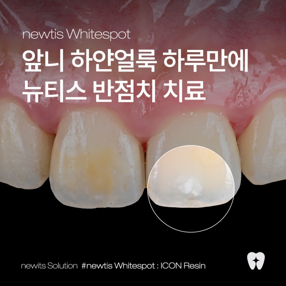앞니 하얀얼룩 반점치 하루만에 치료, 원인과 사례까지! / 강남레옹치과 관련 이미지 1