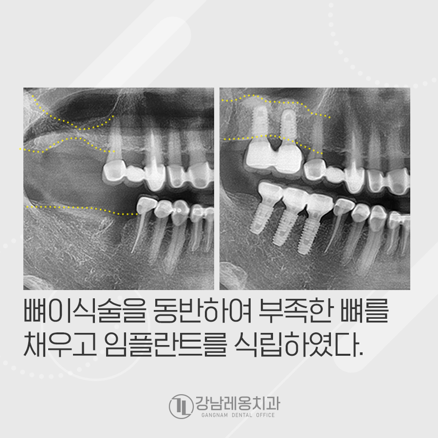 어금니 충치 미루면 임플란트 수술 할 때 뼈이식도 관련 이미지 5