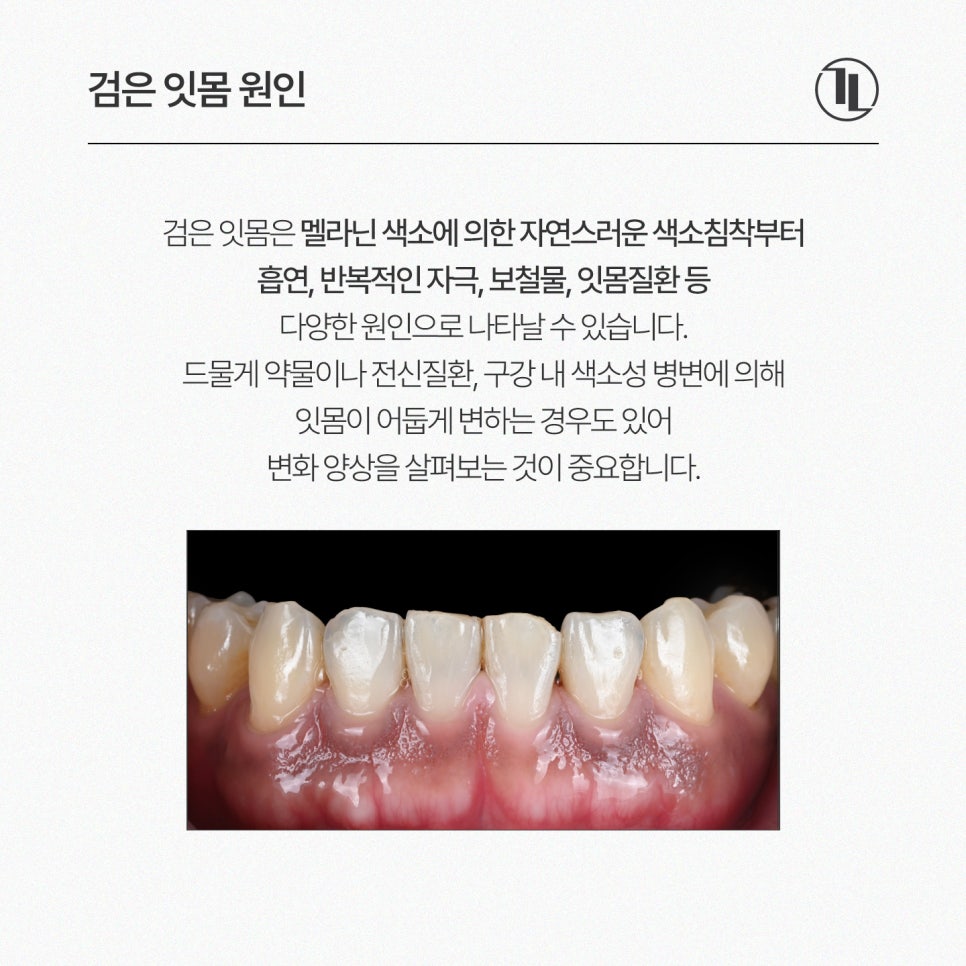 검은 잇몸, 원인부터 잇몸미백 치료과정, 주의사항까지 한눈에 보기👀 / 강남레옹치과 관련 이미지 2