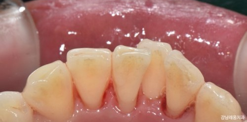 치아 스케일링 후 이시림 / 식사는? / 강남레옹치과 관련 이미지 4