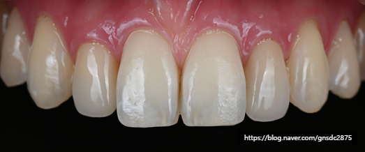 앞니에 하얀얼룩이? 앞니 길이가 달라요! / 앞니통합치료 뉴티스 반점치료 + 치아성형✨ / 강남레옹치과 관련 이미지 7