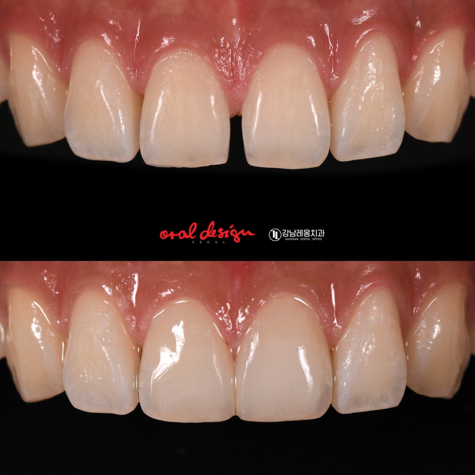 치아 벌어짐 / 앞니 사이 간격 넓어짐 / 정중이개 원인의 증상 그리고 개선할 수 있는 방법에 대해 관련 이미지 7