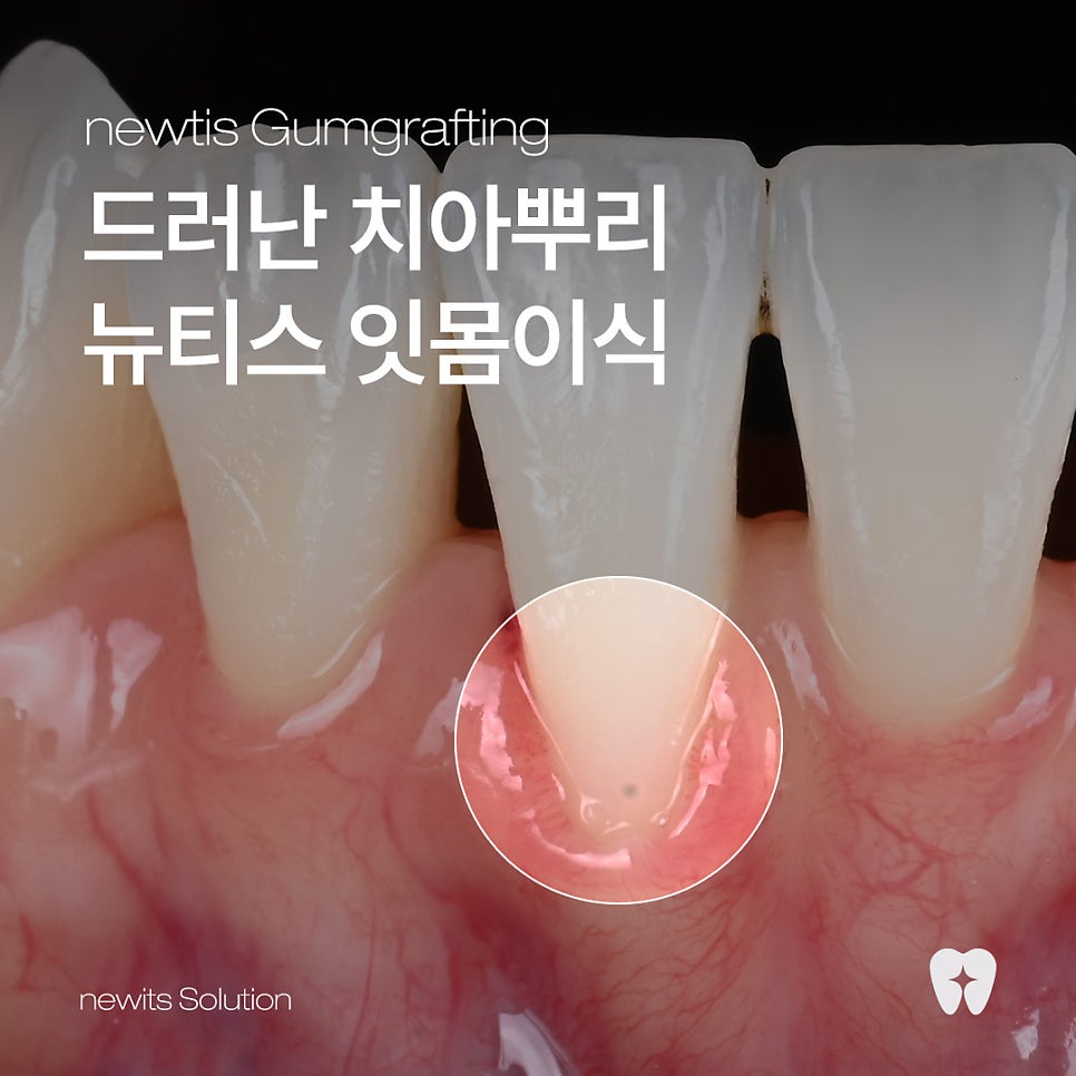 잇몸 내려앉음, 잇몸퇴축 잇몸이식으로 개선 / 강남레옹치과 관련 이미지 1