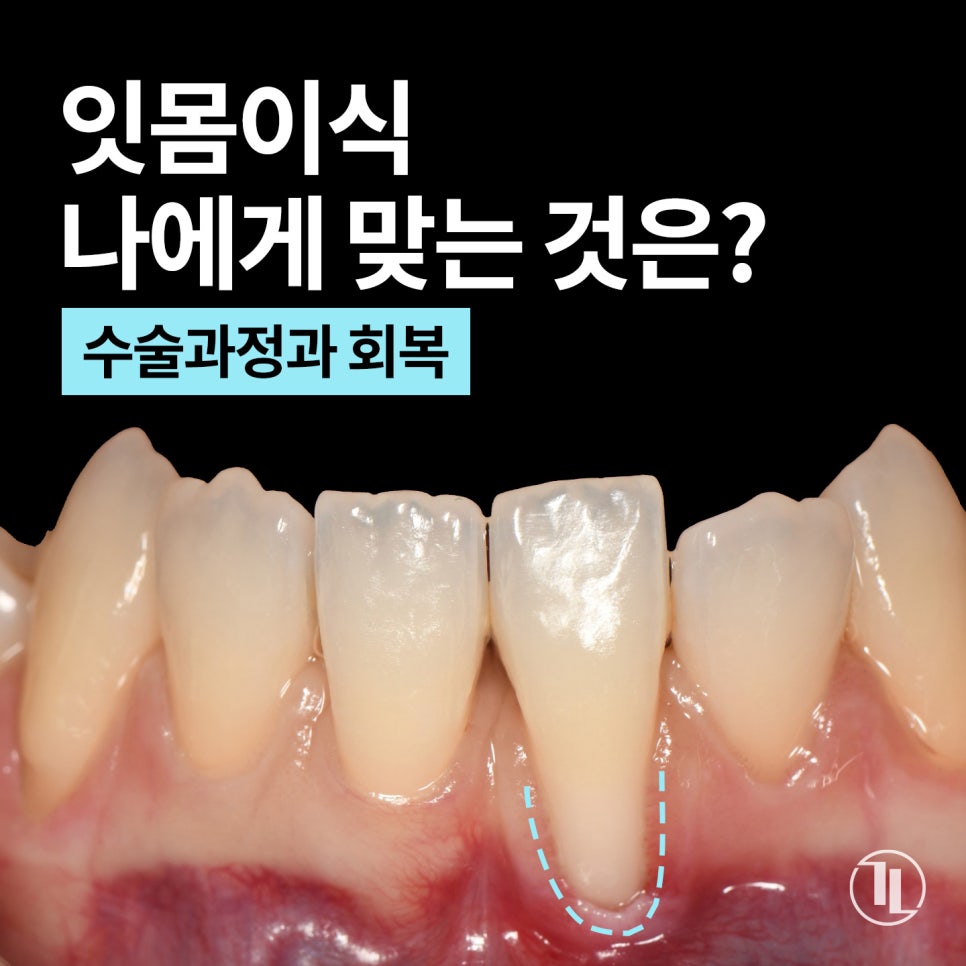 잇몸이식 나에게 맞는 것은? 회복기간 & 주의사항, 이것만은 꼭! / 강남레옹치과 관련 이미지 1
