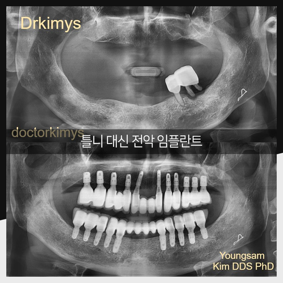 강남레옹치과 임플란트 수술 증례 한눈에 보기, 명불허전! 관련 이미지 7