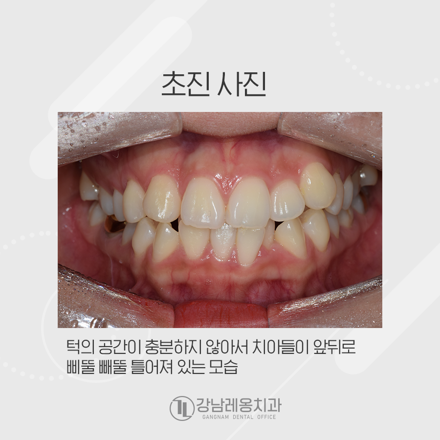 치아총생 덧니를 가지런하게 교정~! 관련 이미지 2