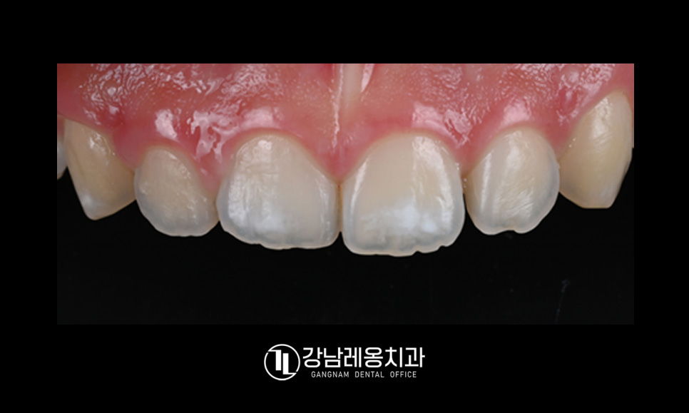 앞니 하얀점, 앞니 반점치 삭제없이 치료! / 아이콘 레진 치료 / 강남레옹치과 관련 이미지 4