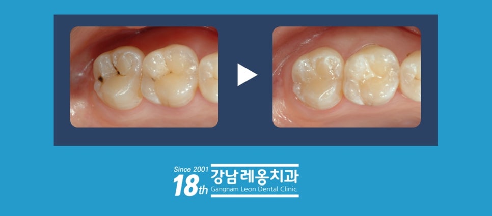 강남레옹치과 레진치료도 건강보험에 적용되었어요! 12세 이하 어린이 영구치 관련 이미지 1