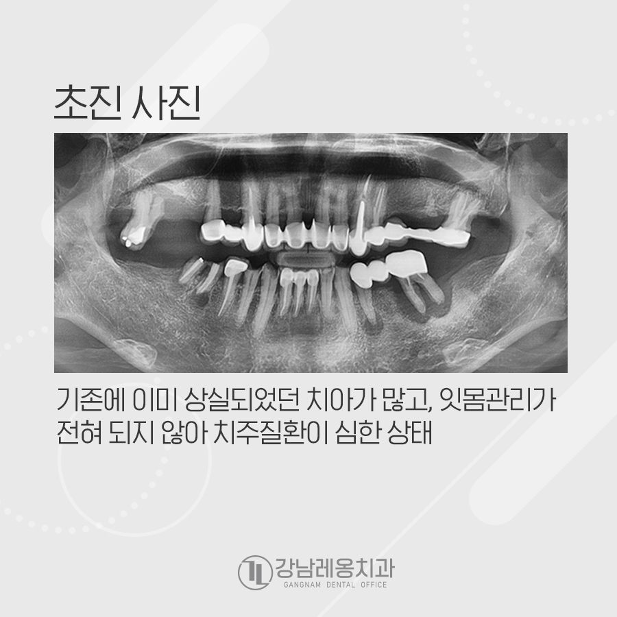 멀쩡한 줄 알았던 오래된 브릿지, 임플란트 수술한 사연 관련 이미지 2