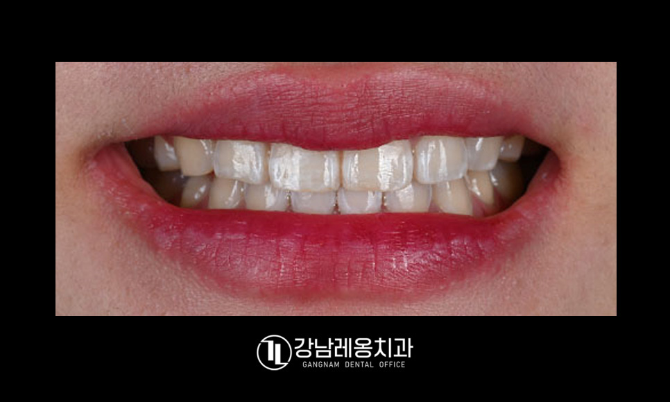 앞니 하얀점, 앞니 반점치 삭제없이 치료! / 아이콘 레진 치료 / 강남레옹치과 관련 이미지 6
