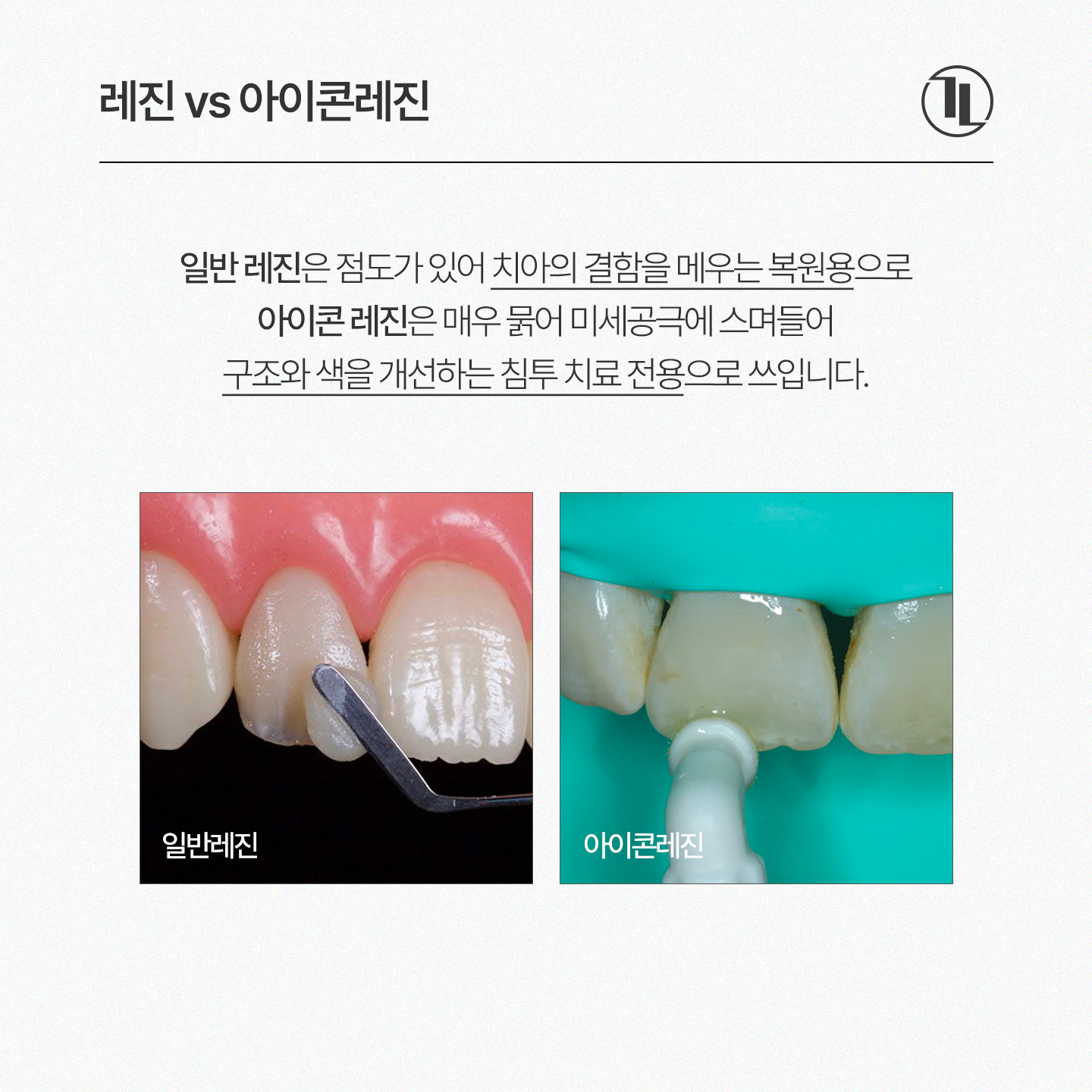 앞니 하얀 얼룩, 반점치 치료 케이스 / 아이콘레진 치료 방법 / 강남레옹치과 관련 이미지 3