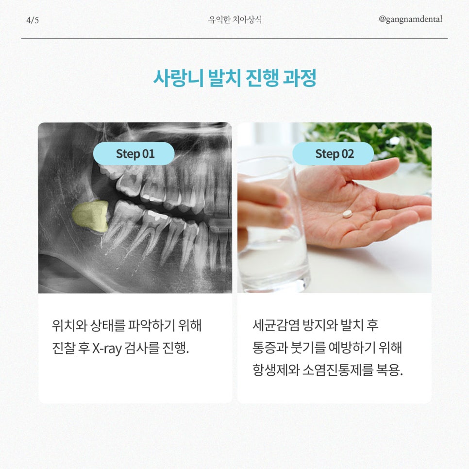 사랑니 발치에 대한 모든것, 사랑니 총정리! / 종류, 비용, 발치과정, 관리, Q&A까지! / 강남레옹치과 관련 이미지 5