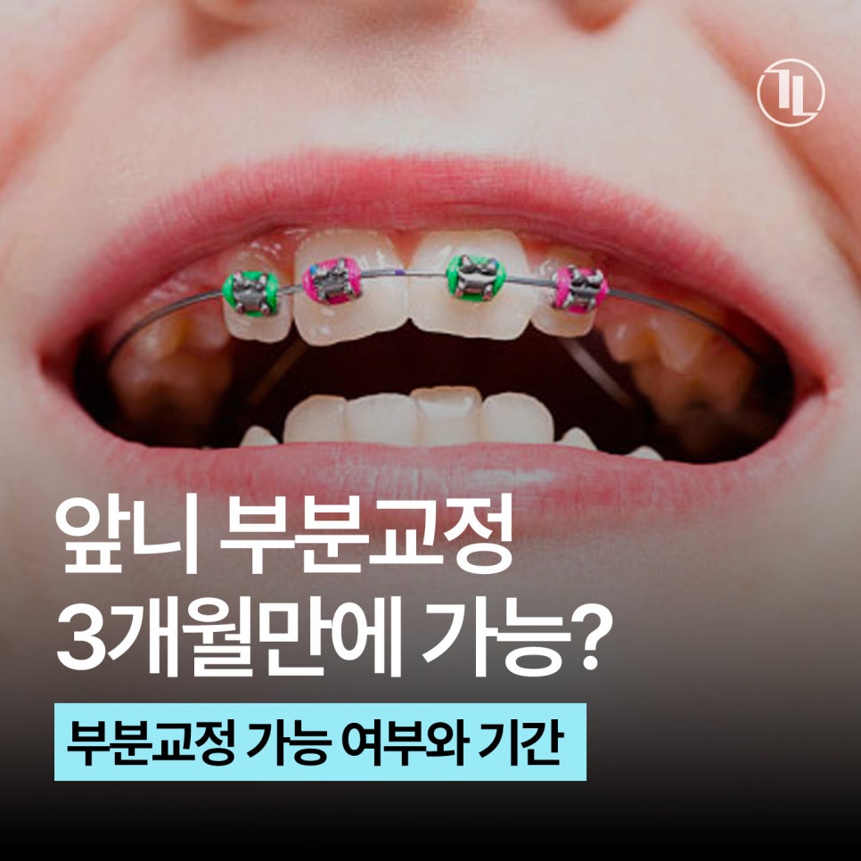 앞니 부분교정 가능여부와 기간 현실 정리! / 강남레옹치과 관련 이미지 1