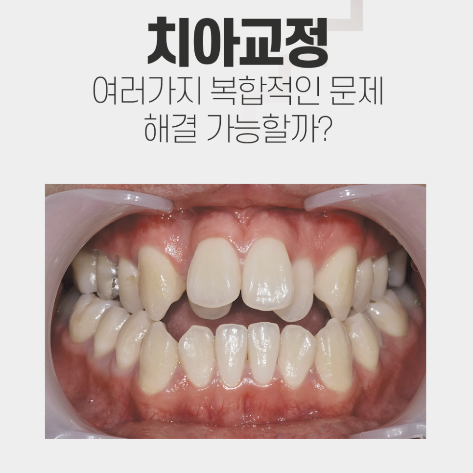앞니가 물리지 않는 개방교합과 주걱턱을 치아교정으로 한번에..? 관련 이미지 1