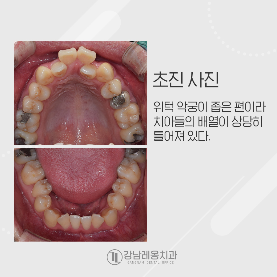 앞니가 물리지 않는 개방교합과 주걱턱을 치아교정으로 한번에..? 관련 이미지 2