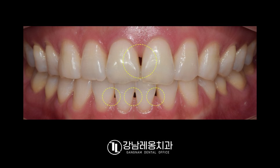잇몸과 치아 사이 공간 &lsquo;블랙트라이앵글&rsquo;을 무시하면 안되는 이유! / 생기는 원인과 해결 방법 / 강남레옹치과 관련 이미지 3