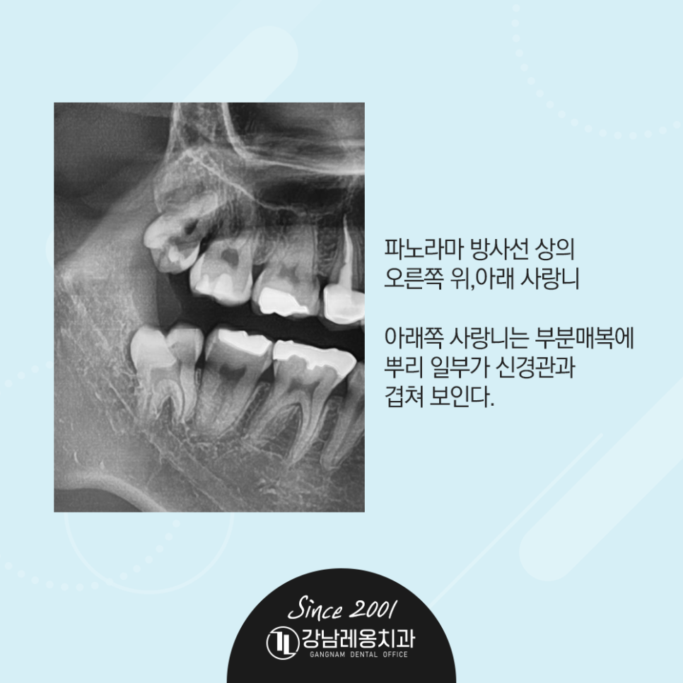 강남레옹치과 사랑니 발치! 통증 붓기 없이 2개를 한번에 뽑은 사례 관련 이미지 3