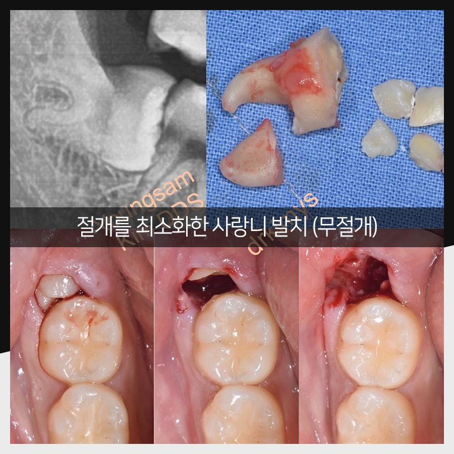 강남레옹치과 사랑니 발치, 결과가 증명해주는 실력! 관련 이미지 17
