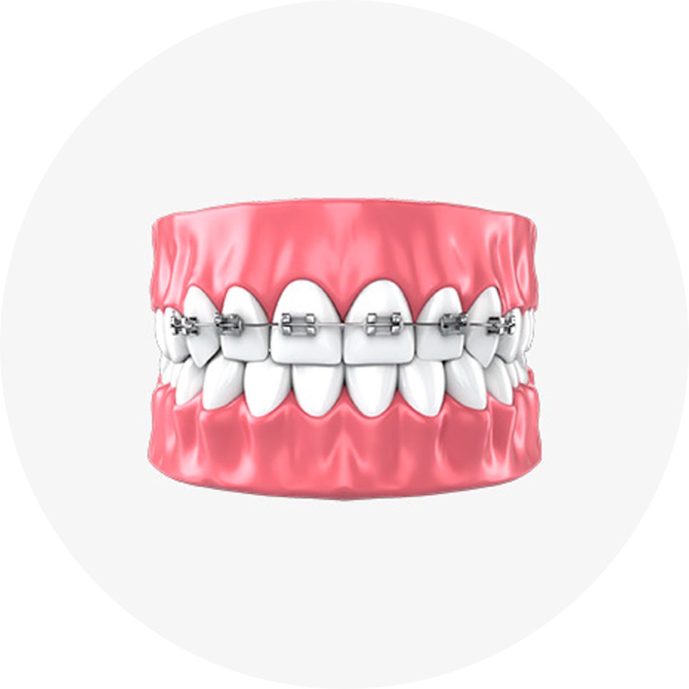 치아교정 종류와 선택법 & 관리 꿀팁 5가지!🖐️ / 강남레옹치과 관련 이미지 7