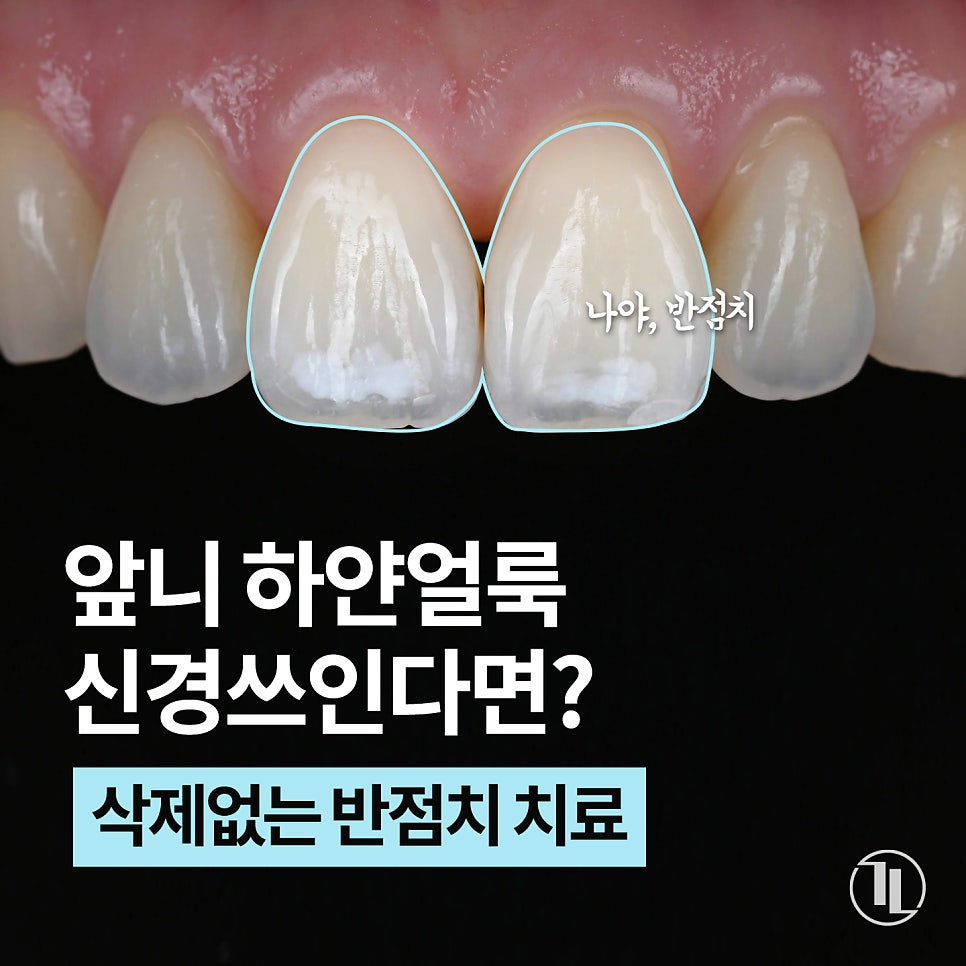 앞니 하얀점, 앞니 반점치 삭제없이 치료! / 아이콘 레진 치료 / 강남레옹치과 관련 이미지 1