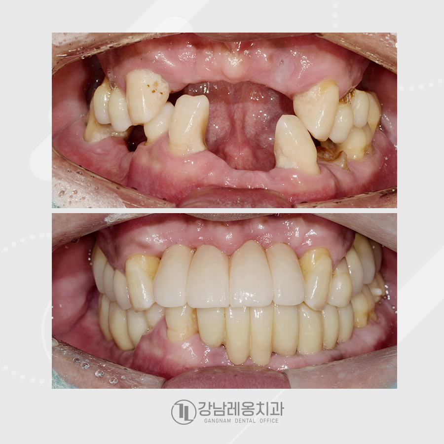 강남레옹치과 전악 임플란트 수술로 심미, 저작 기능을 회복해요. 관련 이미지 6