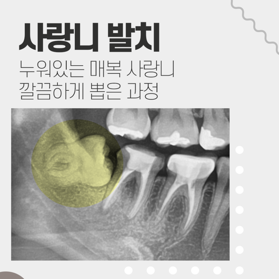 누운 사랑니 발치 통증 없이 깨끗하게 아물었던 강남레옹치과 증례 관련 이미지 1
