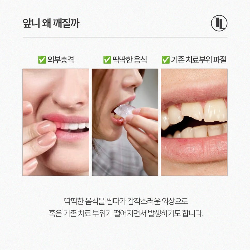 앞니가 깨졌다면?! 4가지 치료방법 비교! / 레진을 선택한 이유 / 강남레옹치과 관련 이미지 2