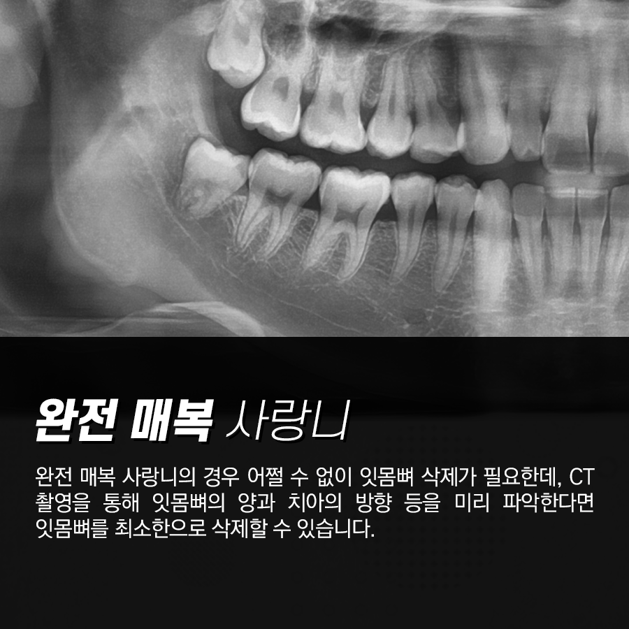 강남레옹치과 사랑니 발치 CT촬영 이유 그리고 비용 안내 관련 이미지 3