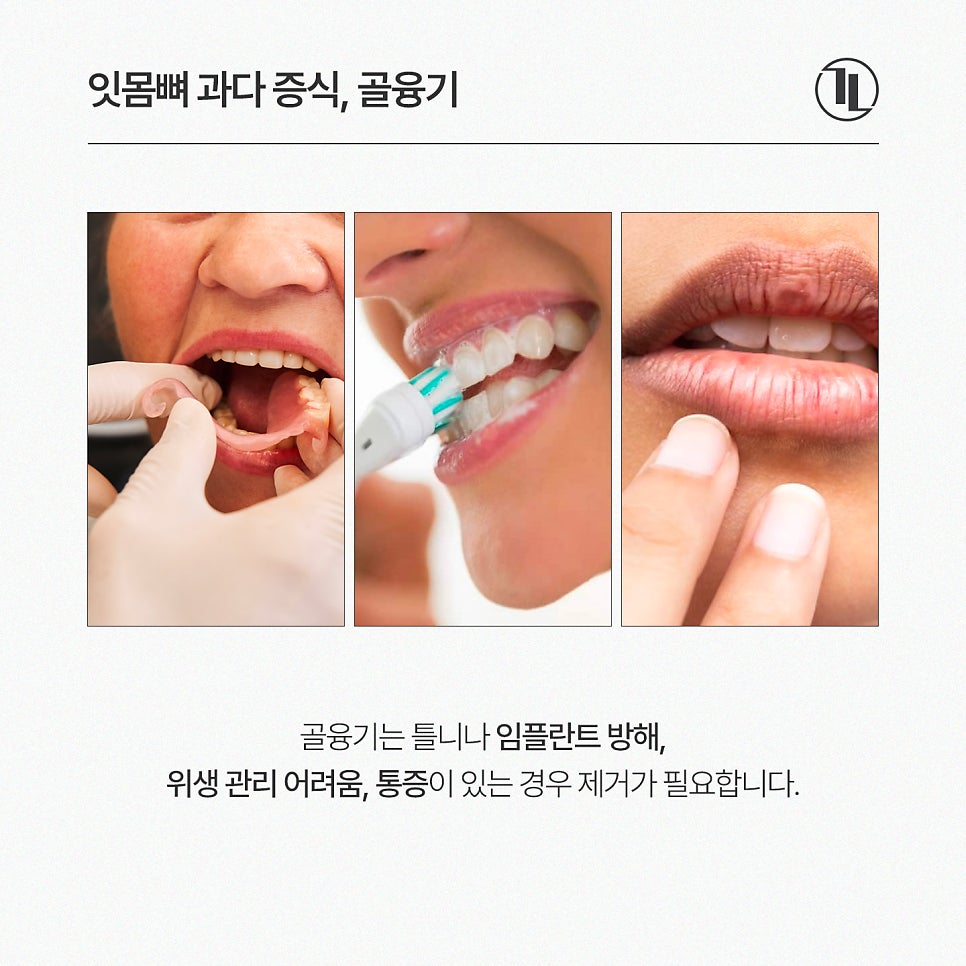 입안에서 느껴지는 딱딱한 이물감? 잇몸뼈 돌출 골융기 제거 / 강남레옹치과 관련 이미지 3