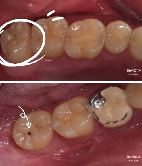 사랑니 발치 후 회복과정 한 눈에 보기🔍 / 강남역 사랑니 강남레옹치과 관련 이미지 2