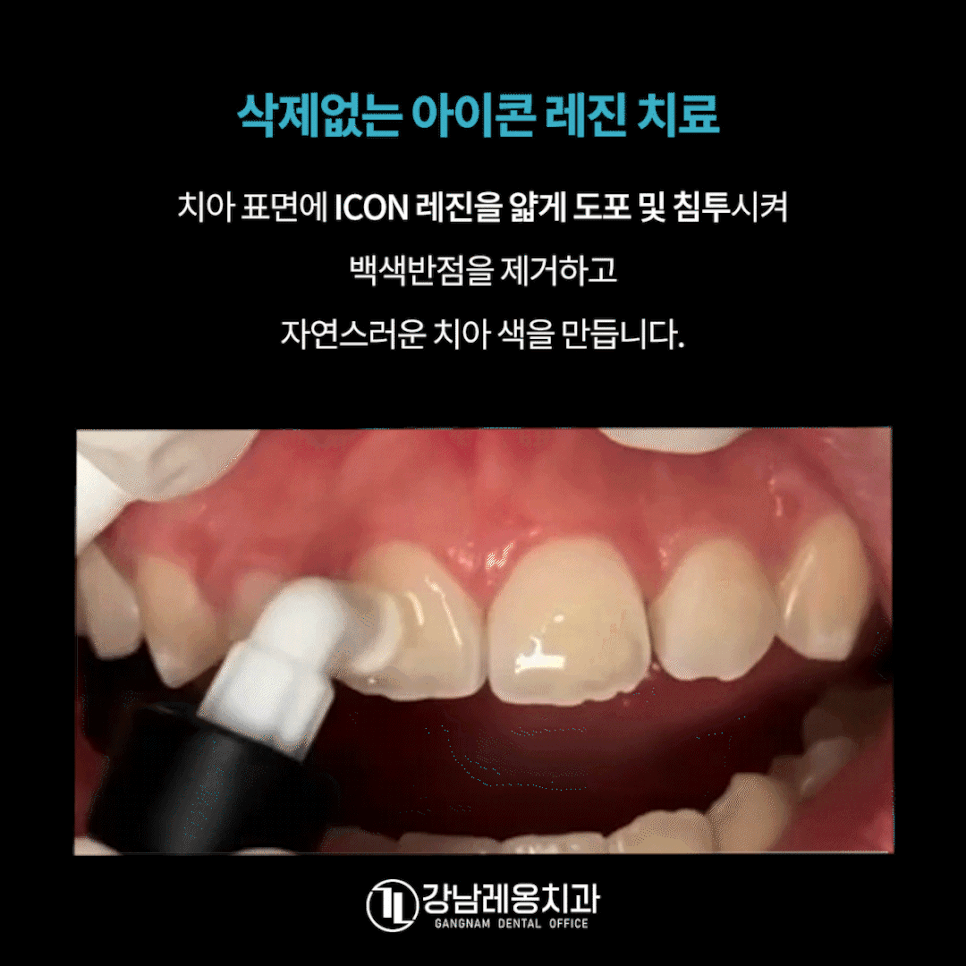 앞니 하얀얼룩 아이콘레진으로 말끔하게 / 뉴티스 반점치치료 / 강남레옹치과 관련 이미지 5