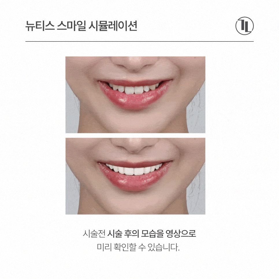뉴티스 스마일 시뮬레이션 - 시술 전 영상으로 미리 확인하는 내 모습! / 강남레옹치과 관련 이미지 2