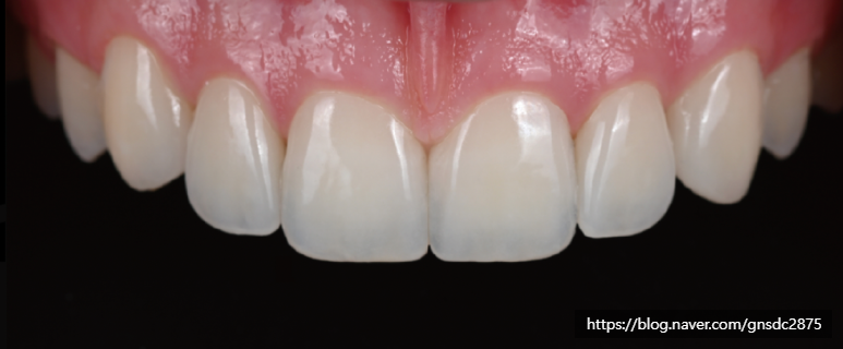 치아가 작아서 콤플렉스? 왜소치 개선 전후 사례👐 / 강남레옹치과 관련 이미지 4